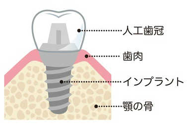 インプラントのイラスト