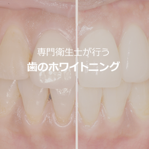 歯のホワイトニングページへ